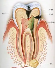 牙髓炎常见分类