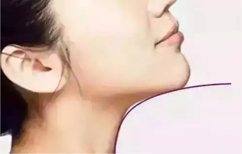  双下巴一直困扰着我,直到我试了这个