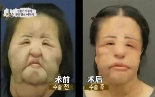  纪实整容上瘾韩慧景自行注射大豆油把脸整成电风扇,代价惨痛