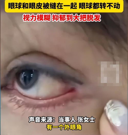  女子花3万割双眼皮,拆线后发现眼球和眼皮被缝在一起,网友炸锅