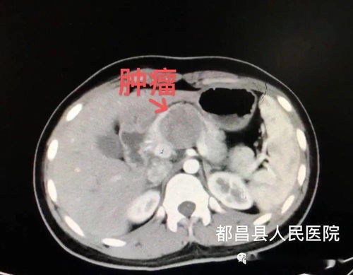 惊险都昌16岁花季少女胰腺长肿瘤,幸亏遇上他们....