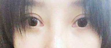  明星双眼皮整形失败是一种怎样的体验