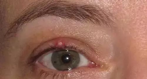  眼皮儿小包块,麦粒肿还是霰粒肿