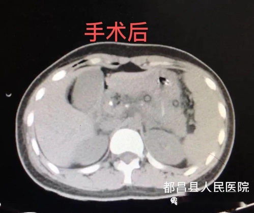  惊险都昌16岁花季少女胰腺长肿瘤,幸亏遇上他们....