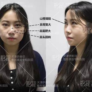  鼻梁太塌口罩戴不紧怎么办漏风,眼镜起雾...悦美整形