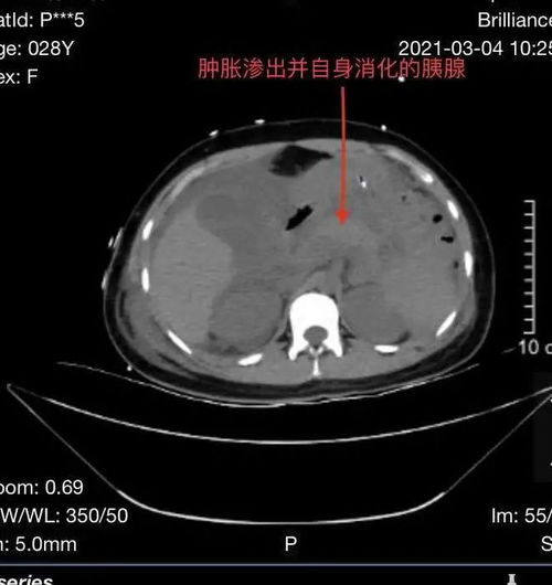  因为一碗猪脏粉,温州年轻女子差点送命