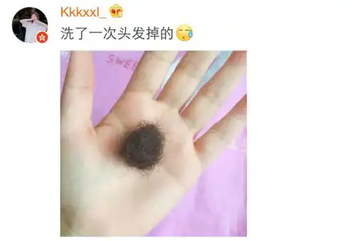  年轻人还怕猝死可怕的是活着的时候变成了秃子