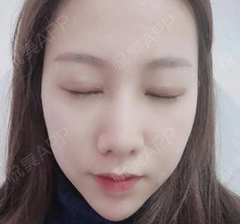  最近眼睛恢复的很好,终于有点双眼皮女孩的味道了,要...眼综合整形悦美整形