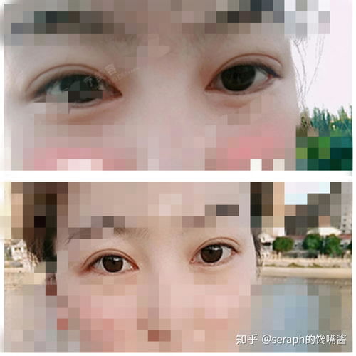  有没有呼和浩特割双眼皮好一点的地方,推荐一下