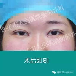  双眼皮术后的蜕变过程