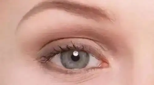  黑眼圈到底是不是肾虚