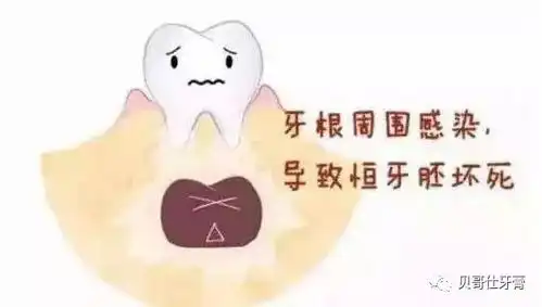  乳牙龋齿蛀牙要不要管
