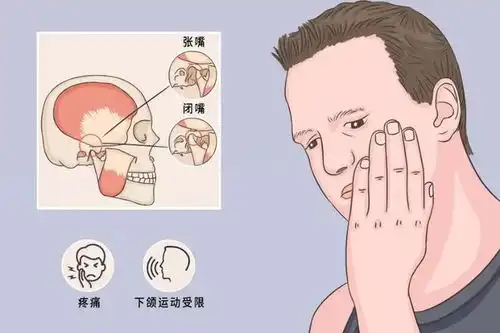  笑掉下巴一文了解颞下颌关节紊乱这种病