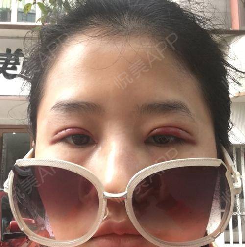  因为天生就是单眼皮,很羡慕有双眼皮的女孩,所以都是...双眼皮悦美整形