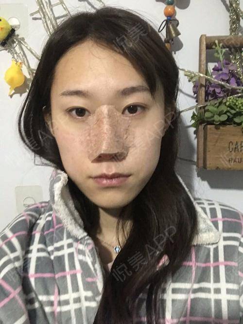  我来啦你们别看我面无表情,不苟言笑,其实我激动劲...垫鼻尖悦美整形