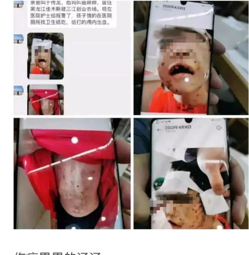  黑龙江遭虐待4岁女童已能喝营养液,继母和生父被批捕,生母已筹集7万善款
