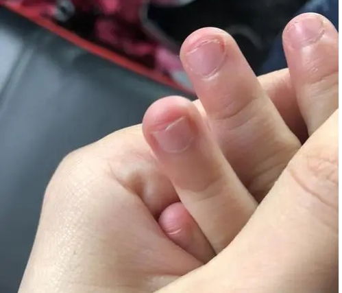  如何才能让小孩戒掉咬指甲,咬手指用苦甲水有用吗