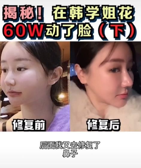  女网红花60万整容换脸,磨骨隆鼻险毁容后又多次整容,脸肿僵硬极不自然