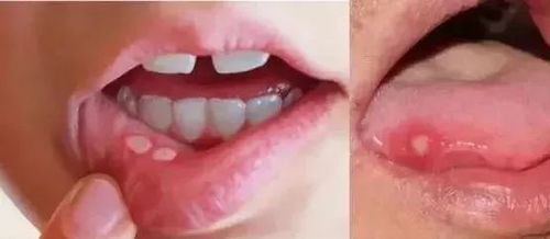 痛痛痛您需要一盒益生菌调节口腔菌群,缓解或治疗口腔溃疡