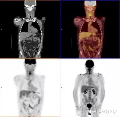  datawhaleai夏令营第三期脑pet图像分析和疾病预测挑战赛最后的挣扎及总结
