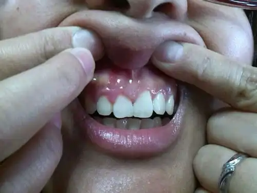  经常牙疼和牙龈肿痛用什么牙膏好一点