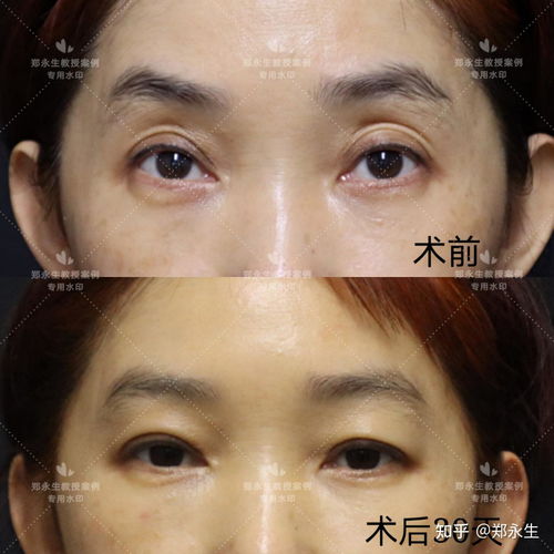  为什么双眼皮比单眼皮显老呢