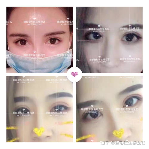  为什么你做的双眼皮这么显老怎样才能有用少女感大眼睛
