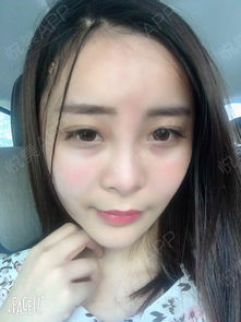  刚回到东莞就被小姐妹们给围观了,都想来看我做完填充...悦美整形