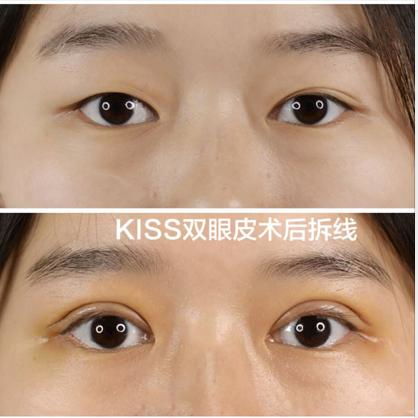  为什么你割完双眼皮还不如别人单眼皮好看