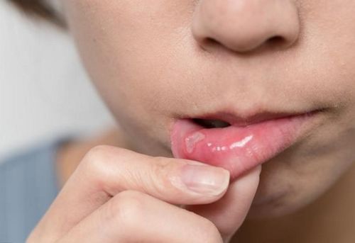  患了口腔溃疡如何处理4个妙招新鲜出炉,不妨一试