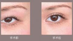  濮阳中韩整形双眼皮整形美容打造迷人电眼